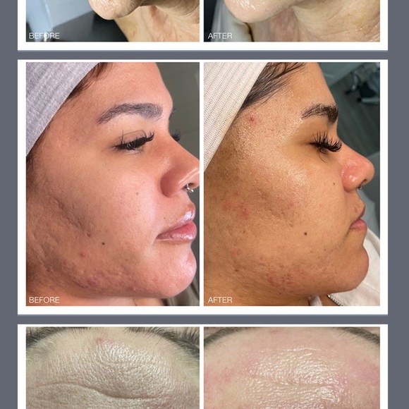 PROFESSIONAL GRADE MICRO-EXFOLIATION PEN MADE BY BIO-THERAPEUTIC - Picture 6 of 13